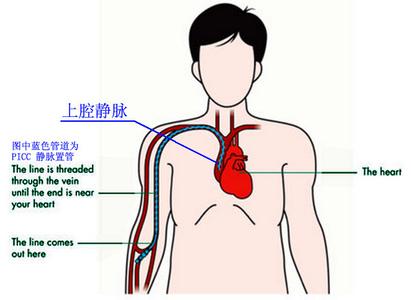 picc是经外周静脉穿刺置入中心静脉导管.